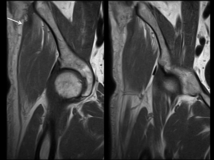 Figure 2 for case iliotibial band ( RID2855 )